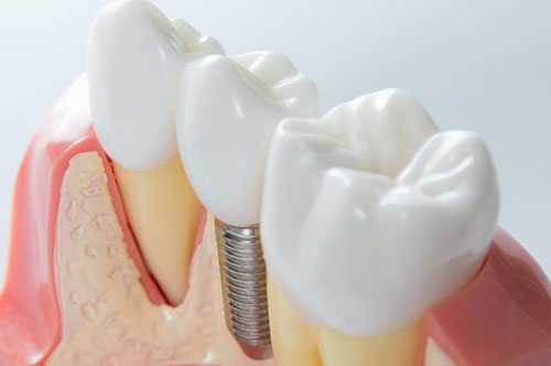 Will Implant-Supported Teeth Help You Eat Again?