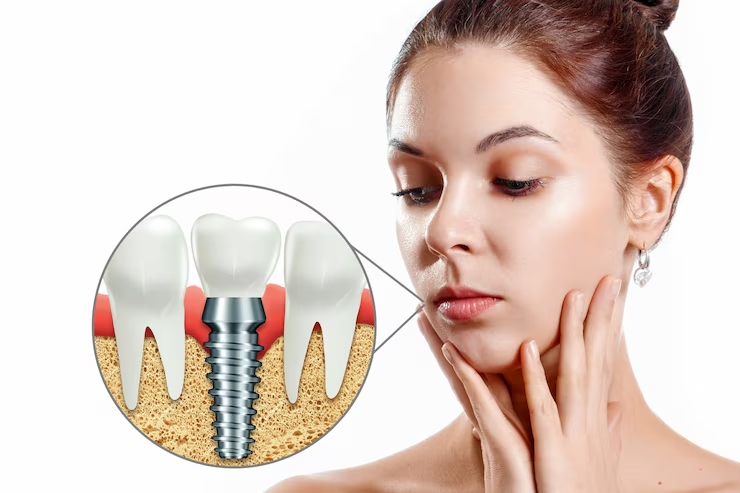 Why Mini Dental Implants Are Gaining Popularity Among Patients